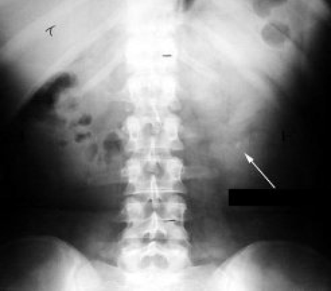 X-ray showing stone in kidney marked by the arrow.