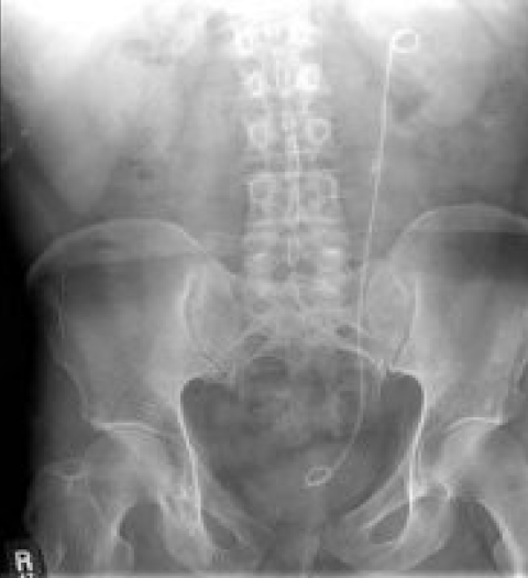 KUB (plain abdominal x-ray) that shows stent in position to bypass stone allowing kidney to drain. (The stent is the long white tube with curls at each end)