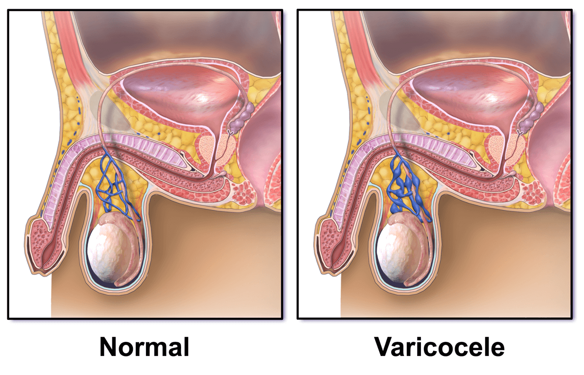 Varicocele