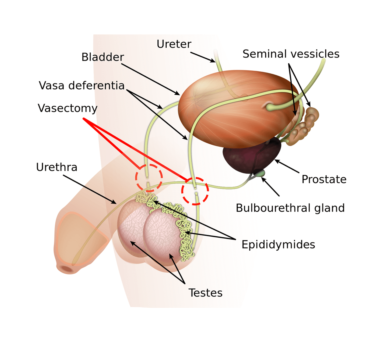 Diagram of vasectomy