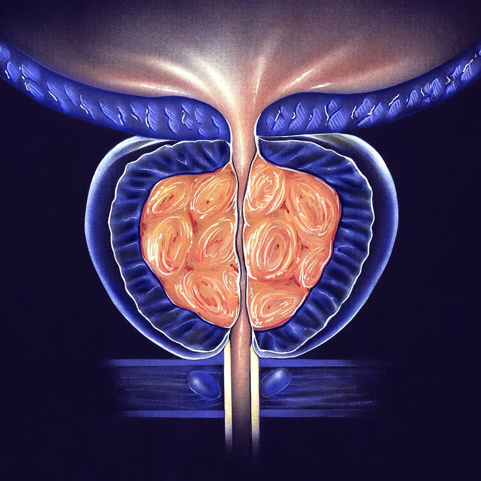 case study 55 benign prostatic hyperplasia