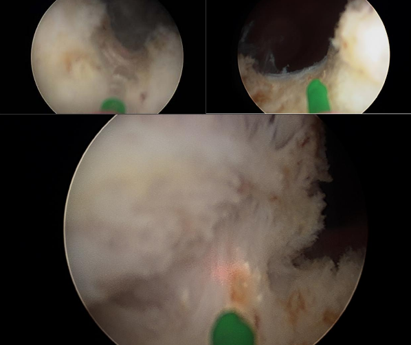 suites énucléation laser prostate surgery