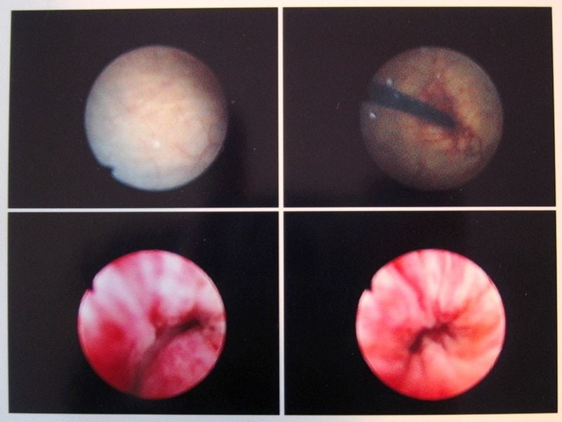 Images from a cystoscopy. The top two images show the interior of a bladder. The top left image shows the bladder wall, the top right shows the cystoscope passing into the bladder from the urethra. The bottom two images show an inflammed urethra. Cystoscopy carried out on Michael Reeve, 29, at the North London Nuffield Hospital].