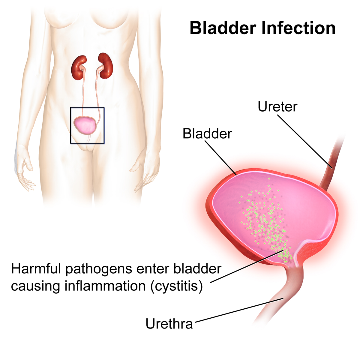 Bladder infection