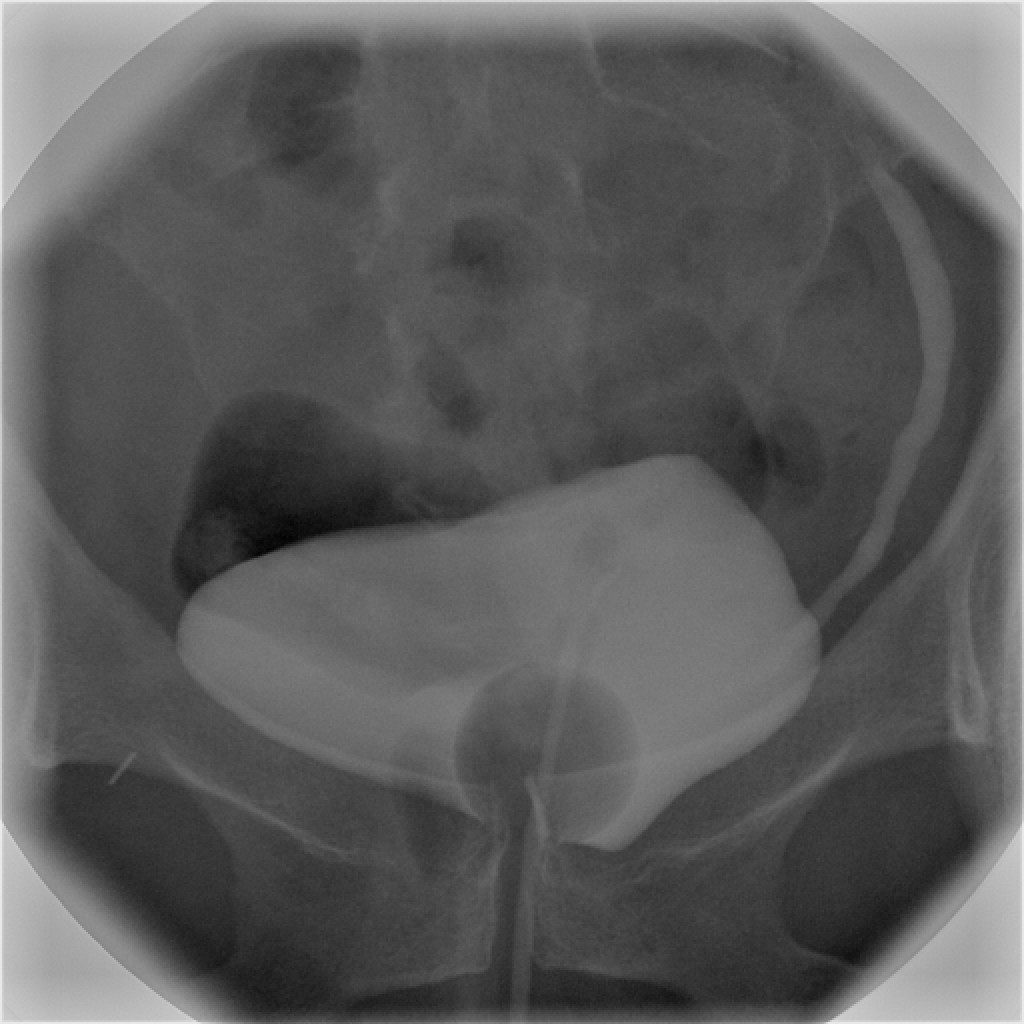 Bladder x-ray showing backwards flow of urine from the bladder into the kidney tube (ureter)
