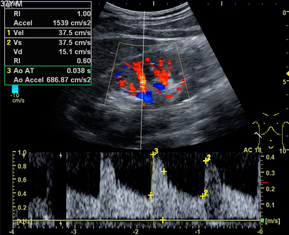 Kidney ultrasound